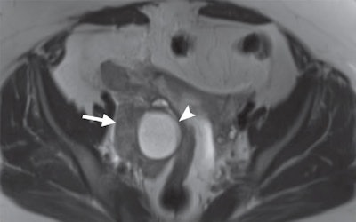 MRI of a 31-year-old woman with a ruptured hemorrhagic ovarian cyst and false-positive interpretation for acute appendicitis. Axial single-shot T2-weighted image shows a right ovarian cyst (above, arrowhead) with complex material along the lateral margin of the cyst (arrow). In retrospect, axial single-shot T2-weighted MRI shows a nonfluid-filled appendix (below, arrow) and no inflammation in the periappendiceal soft tissues. The patient underwent subsequent surgery. Images courtesy of Radiology.
