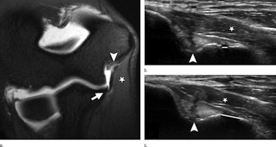Images are of a 21-year-old baseball pitcher with a full-thickness UCL tear. MR arthrography (a) and corresponding medial elbow ultrasound exams at rest (b) and with stress (c). Full-thickness tear at the proximal UCL (arrowhead) and additional small partial-thickness tear at the distal UCL (arrow). Normal common flexor muscle bulk (star) is also shown. Substantial gapping (5.7 mm) at the ulnotrochlear joint between rest (rest gap: 2.0 mm, white line in b) and stress (stress gap: 7.7 mm, white line in c) is illustrated. Image courtesy of Radiology.