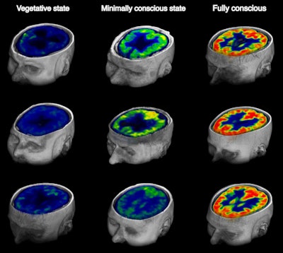 Images show brain glucose metabolism as seen on FDG-PET at rest in patients with chronic disorders of consciousness and fully conscious control subjects. There is a significant reduction in brain glucose metabolism from full consciousness to the minimally conscious state and unresponsive wakefulness syndrome. Images courtesy of Stender et al.
