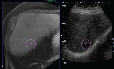 Top: After a patient was referred for biopsy to further characterize a lesion with a nonspecific appearance on liver MRI, ultrasound fusion software was used to localize and biopsy the lesion. Bottom: The red arrow on the right panel points to the needle tip. All images courtesy of the Journal of Ultrasound in Medicine.