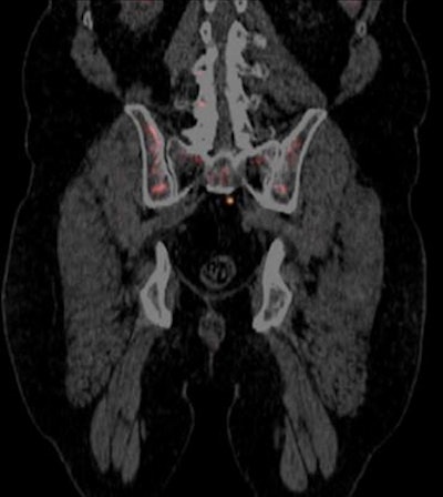 PET scan with Blue Earth's Axumin radiopharmaceutical. Image courtesy of Blue Earth Diagnostics.