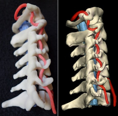 Physical 3D-printed multicolor nylon model (left) demonstrating the cervical vertebrae, vertebral arteries, thecal sac, and cord. Virtual version (right) of the printed model shows the same structures. 3D printing by WhiteClouds in Ogden, UT. Images courtesy of Dr. Justin Cramer and Dr. Edward Quigley, PhD.