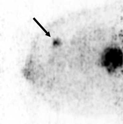 A 36-year-old woman with a large triple-negative ductal type carcinoma has two FDG-avid lesions on Mammi-PET. Arrow indicates smaller lesion.
