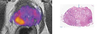 MRI (left) shows the prostate enhanced with RSI. The higher-grade tumor is indicated in orange and yellow. The image on the right shows a digitized section of the prostate with the tumors outlined with dotted lines. Images courtesy of Clinical Cancer Research.