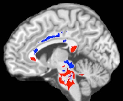 DTI-MRI of a concussion patient's brain. Areas of low fractional anisotropy (red) indicate injured white matter, while high fractional anisotropy areas (blue) suggest more efficient white-matter connections compensating for concussion damage. A large amount of high fractional anisotropy can predict recovery from a concussion. Image courtesy of Albert Einstein College of Medicine.
