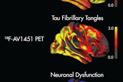 Image shows the topographical correspondence of tau but not amyloid pathology with neuronal dysfunction in Alzheimer's disease. The right lateral surface of projected z-score images reflects deviation from healthy controls. Yellow/red indicate higher uptake, while blue denotes lower uptake compared to controls. Image courtesy of Bischof et al and SNMMI.
