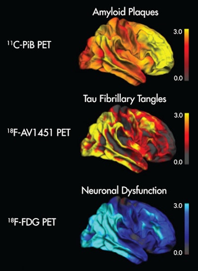 Image shows the topographical correspondence of tau but not amyloid pathology with neuronal dysfunction in Alzheimer's disease. The right lateral surface of projected z-score images reflects deviation from healthy controls. Yellow/red indicate higher uptake, while blue denotes lower uptake compared to controls. Image courtesy of Bischof et al and SNMMI.