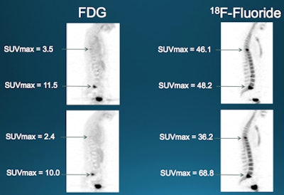 A 49-year-old woman with a first recurrence of breast cancer at time of the study 12 years after primary treatment. FDG decreased somewhat between scans, while fluoride-PET showed both increased and decreased SUVs. The patient was treated with letrozole (plus Herceptin) and switched to Faslodex after these scans. She eventually died of her disease seven years later. Image courtesy of Lanell Peterson.