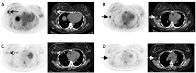 Images are from a 43-year-old woman with invasive lobular breast cancer. Axial fluciclovine-PET/CT (A) demonstrates a fluciclovine-avid (SUV 4.9) primary right breast malignancy (arrows). Axial fluciclovine-PET/CT (B) shows a fluciclovine-avid (SUV 5.8) right axillary nodal metastasis (short arrows). Axial FDG-PET/CT (C) shows near background FDG avidity (SUV 1.8) in the right breast malignancy (dashed arrows). Axial FDG-PET/CT (D) shows only mild FDG avidity (SUV 2.8) in the right axillary nodal metastasis (short dashed arrows). Image courtesy of Dr. Gary Ulaner and SNMMI.