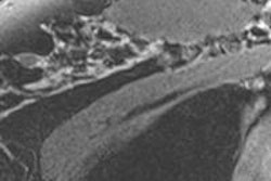 2016 06 22 15 06 22 971 Supine Image G Gombos 400 20160622221400