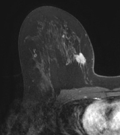 MR images are from a 43-year-old patient who underwent lumpectomy in the OR imaging suite for a 2-cm right upper inner quadrant invasive mixed ductal and lobular cancer. The prone MRI (above) is a postcontrast axial T1-weighted fat-suppressed MR sequence that shows rapid enhancement of the tumor. The postprocedural supine unenhanced axial T1-weighted fat-suppressed MRI (below) taken in the OR imaging suite shows the tumor cavity and the skin markers. Images courtesy of Radiology.