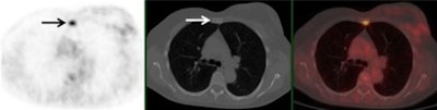 A 61-year-old woman with initial stage IIB triple-negative breast cancer was upgraded to stage IV. Axial PET, CT, and fused FDG-PET/CT show an FDG-avid osseous metastasis without CT correlate (arrows). A biopsy confirmed the metastasis. Image courtesy of Raychel Castillo and the SNMMI.