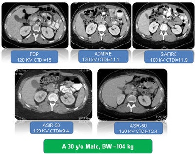 30-year-old man followed up with multiple CT protocols at different time points. Image quality has been equalized to eliminate excessive noise or texture changes that could complicate interpretation. Image courtesy of Dr. Dushyant Sahani.