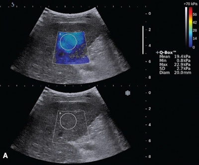 Shear-wave elastography (top) and endoscopy (bottom) of a 59-year old woman with a F2 varix. The median liver stiffness on shear-wave elastography was 19.3 kPa. Images courtesy of the Journal of Ultrasound in Medicine.