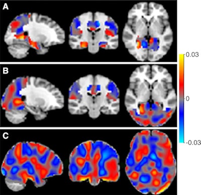 The classifiers can be represented as discrimination maps, where red indicates that the intensity at that location contributes to the likelihood of the images belonging to the more-advanced stage, and blue to the likelihood of belonging to the less-advanced stage. A: Alzheimer's disease (AD) vs. SCD; B: AD vs. MCI; and C: MCI vs. SCD. Image courtesy of RSNA.