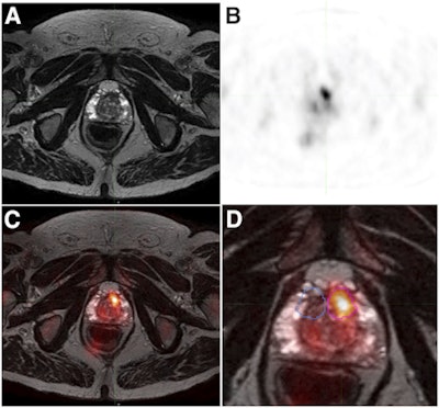 T2-weighted fast spin-echo MRI (A), F-18 choline PET (B), and fused PET/MRI (C) show a 0.68-cm3 left anterior transitional zone lesion that was confirmed on targeted biopsy. A magnified view of PET/MRI (D) shows a target lesion (magenta) and respective mirrored (blue) background volumes of interest. Image courtesy of JNM.