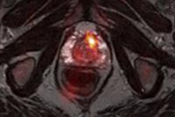 2016 07 12 10 18 53 943 Prostate Mri Pet 450 20160712172119