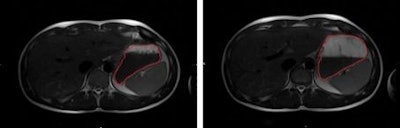 Above, MRI shows a subject with the small volume of water (left) and the larger volume (right), delineated in red. Below, brain scans showed that activation in the insula increased when the stomach was more distended. Image credit: G Camps, R Veit, M Mars, C De Graaf, P Smeets.