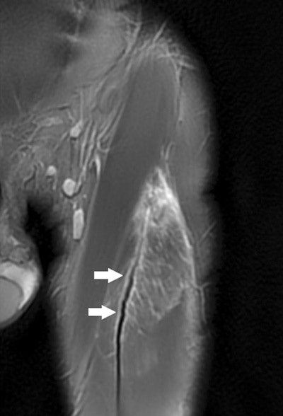 Tendon waviness. Coronal proton density-weighted image shows tendon waviness (short, thick arrows) accompanying an extensive rectus femoris lesion.