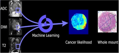 Schematic of machine-learning algorithm for detecting prostate cancer on multiparametric MRI. Image courtesy of Dr. Nelly Tan.