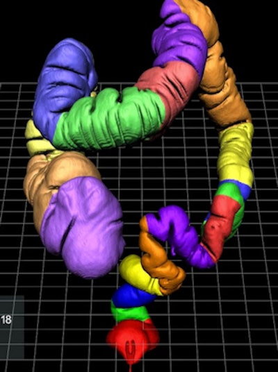 EchoPixel's CT colonography software displays colonic segments.