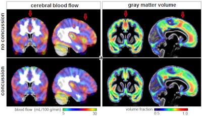 Brain MR images plot the average cerebral blood flow (left panel) and gray-matter volume fraction (right panel) for athletes with and without a history of concussion. Red arrows denote areas where concussed athletes showed significantly lower blood flow and gray-matter volume. Images courtesy of Nathan Churchill, PhD, and St. Michael's Hospital.