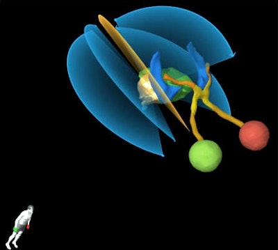 New cranial radiosurgery software from Brainlab incorporates patient-specific arc trajectories with a new algorithm.