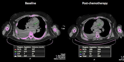A 71-year-old man with non-Hodgkin's lymphoma had a total calcium score of 637 on his baseline PET/CT. When the scan was performed one year later after two cycles of chemotherapy, it showed a significant increase in calcium deposition and a calcium score of 817. Image courtesy of Dr. Ahmed El-Sabbagh.