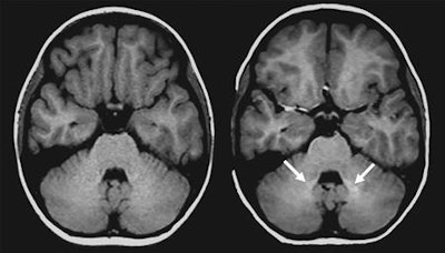 Axial unenhanced T1-weighted spin-echo brain MRI shows that dentate nucleus signal intensity increases with repeated exposure to linear GBCA. Left scan is of a 6-year-old girl before contrast material exposure; right scan is of the same patient at 9 years of age after eight GBCA-enhanced scans. Arrows indicate increased bilateral signal intensity in the dentate nucleus. Image courtesy of Radiology.