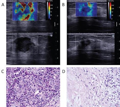 Shear-wave elastograms and corresponding pathologic images from a 59-year-old woman with breast cancer. (A) The patient's mean tumor stiffness value at baseline was 223.1 kilopascals (kPa). (B) After the second chemotherapy cycle, the mean tumor stiffness value had dropped to 44.7 kPa, representing a 77.9% reduction in tissue stiffness. (C) Before chemotherapy, the neoplastic cells showed pleomorphism with hyperchromatic nuclei, as observed under an optical microscope. (D) After surgery, the pathologic result was a complete response. The specimen showed a broad range of necrosis, fibrosis, loose tissue edema, and inflammatory cell infiltrations but was without cancer cells. Images courtesy of the Journal of Ultrasound in Medicine.
