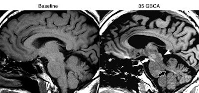 T1-weighted MRI of a 61-year-old man with left frontal glioblastoma shows high signal intensity in the colliculi (arrowhead), red nucleus and substantia nigra (white arrow), and superior cerebellar peduncle (black arrow) after 35 GBCA administrations, compared with baseline MRI prior to GBCA. Images courtesy of Radiology.