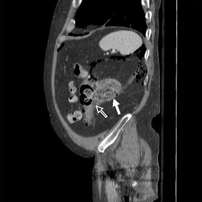 Sagittal (above) and axial (below) contrast-enhanced CT images of the abdomen and pelvis are from a 62-year-old man with abdominal pain. Images show a large collection posterior to the descending colon (white arrow) containing feculent material adjacent to multiple diverticula and a sizeable defect in the colon wall (hollow arrow). The initial management strategy was percutaneous drain placement; however, from the conference, the surgical team learned that the size of the defect was much larger than they had realized. The patient underwent descending colectomy with transverse colostomy. Images courtesy of Dr. Matthew Davenport.