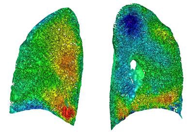 Image from a preclinical study of human lungs. The colors depict ventilation measured from the algorithm's viewpoint mapped onto CT.