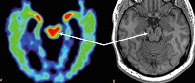 Increased FDDNP signal in the midbrain on brain PET (A) of an NFL player with suspected CTE. The image correlates to midbrain volume loss in the case study by Raji et al (B) from the four-year follow-up MRI of the study subject. (Image A adapted from Barrio et al., 2015.) Images courtesy of UCLA Health.
