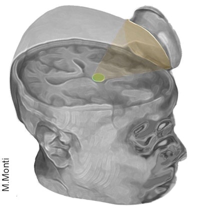 The low-intensity focused ultrasound pulsation technique excites neurons in the thalamus. Image courtesy of Martin Monti, PhD.