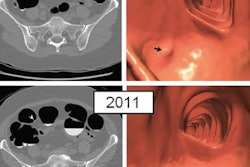 2016 08 30 16 21 04 49 2016 08 31 Figure1 Pickhardt Polyps 20160830232136