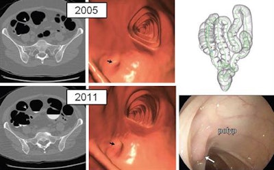Diminutive polyp at initial CTC screening grew to small size at follow-up screening six years later in an asymptomatic woman (61 years old at initial screening). Top: 2D (left) and 3D (middle) images from initial 2005 screening show diminutive lesion (arrowhead for 2D, arrow for 3D) smaller than 5 mm in the proximal transverse colon. Bottom: 2D (left) and 3D (middle) images from repeat CTC in 2011 show that the sessile polyp has grown in the intervening six years, now measuring 7 mm. Polyp was confirmed (arrow) and removed at same-day colonoscopy (right) and proved to be a tubular adenoma at pathologic evaluation. Images republished with permission of RSNA from Radiology, August 22, 2016.