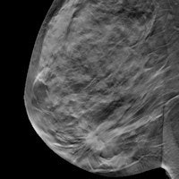 Digital breast tomosynthesis