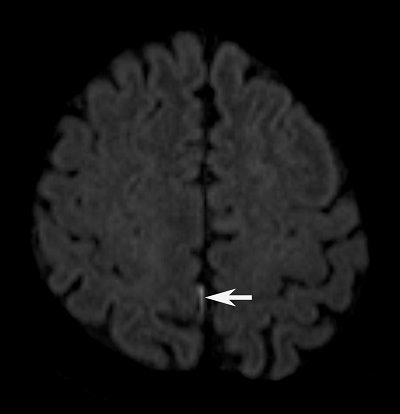 DWI pinpoints a tiny hyperintensity spot (arrow) in the posterior right fissure. Image courtesy of Dr. C.C. Tchoyoson Lim.