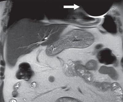 Coronal T2-weighted image shows susceptibility artifact related to cardiac implantable electronic device (arrow), which limited evaluation of portions of left anterior chest wall, lingula, and heart. Image courtesy of AJR.
