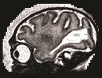 Sagittal MRI of the fetal brain of a pigtail macaque infected with the Zika virus. The large white region is abnormal and indicates an accumulation of fluid in the brain. Image courtesy of the University of Washington.