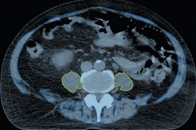 Axial CT images obtained in a 71-year-old man. Above, the bilateral psoas muscles (yellow) and total muscle area (blue and yellow) are delineated. Below, the vertebral body trabecular bone (green) is delineated. Images republished with permission from RSNA.