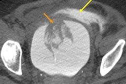 2016 09 14 11 09 46 147 2016 09 Baghdanian Extraperitoneal Rupture Top2 Thumb