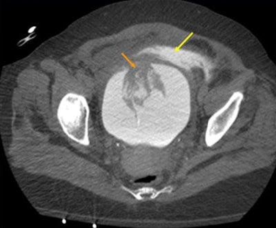 Simple extraperitoneal rupture seen in a CT scan of a 55-year-old man who fell down five concrete steps. Gross hematuria in the Foley catheter was noted. CT cystogram demonstrates a large anterior bladder wall defect (orange arrow) with contrast seen pooling in the pelvic extraperitoneal space (yellow arrow). The patient was taken to the operating room and found to have an 8-cm longitudinal bladder perforation. Images courtesy of Dr. Arthur Baghdanian.