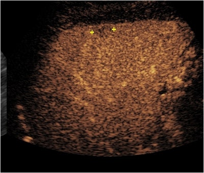 Above, at one minute and 36 seconds after contrast injection, the mass (marked by calipers) shows very faint reduction in enhancement and washout. Below, at four minutes and 35 seconds after contrast injection, the mass is now showing more marked washout. The arterial phase hyperenhancement and slow washout shown in this CEUS study are classic features of HCC.