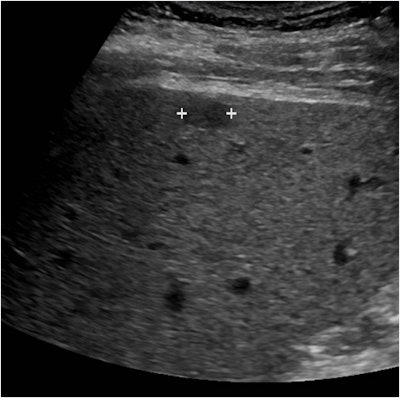 Above, small superficial hypoechoic mass (marked by calipers) in the cirrhotic liver of a 64-year-old man. Below, at 17 seconds after contrast injection, the mass is hypervascular relative to the remainder of the liver and appears brighter on this image. All images courtesy of Dr. Stephanie Wilson.