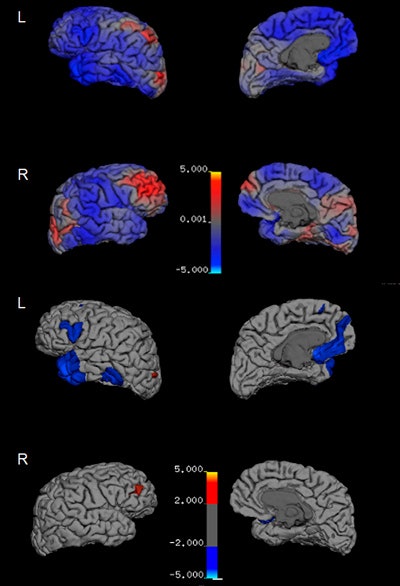 Maps show percentage change in cortical thickness from 2011 to 2015 across brain hemispheres. Top panel displays changes in thickness from 0% to 5% with no cutoff. Bottom panel shows changes in thickness greater than 2%. Image courtesy of Translational Psychiatry.