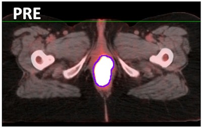 PET/CT images show a pretreatment scan (above) and post-treatment scan (below) of a patient with vulvar cancer who had a complete response to chemoradiation therapy. Images courtesy of Divya Natesan and Duke University.