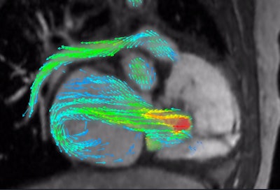4D Flow depicts severe regurgitation on right-ventricular three-chamber view. Image courtesy of Arterys.