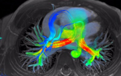 4D Flow software for cardiac MRI shows streamlines of shunted pulmonary venous flow back out to each pulmonary artery. Image courtesy of Arterys.
